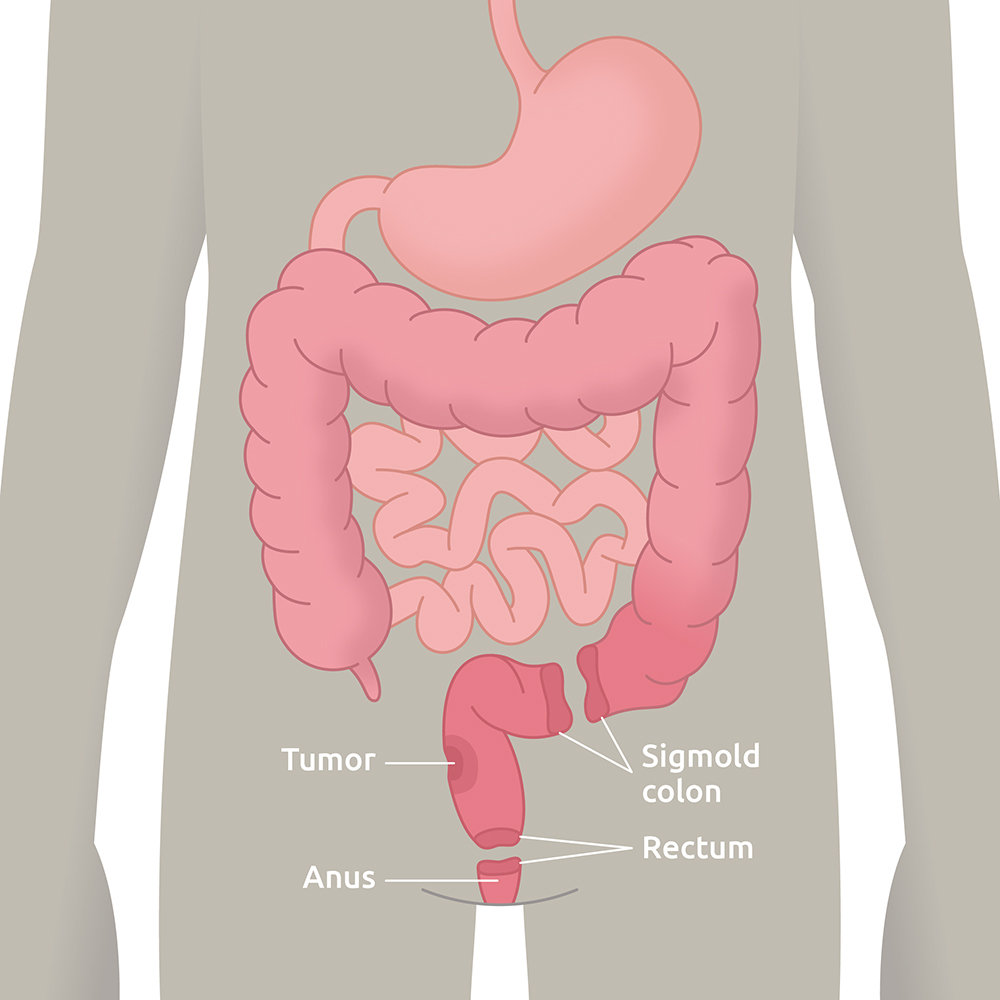 Low Anterior Resection Syndrome