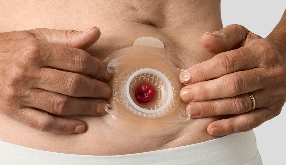 A mirror image of the peristomal plane through depth and slope