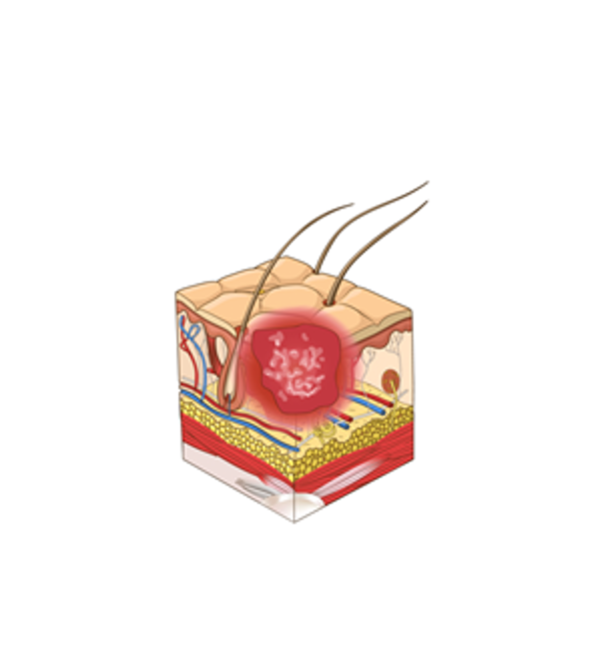 Stage 2: Partial-thickness skin loss