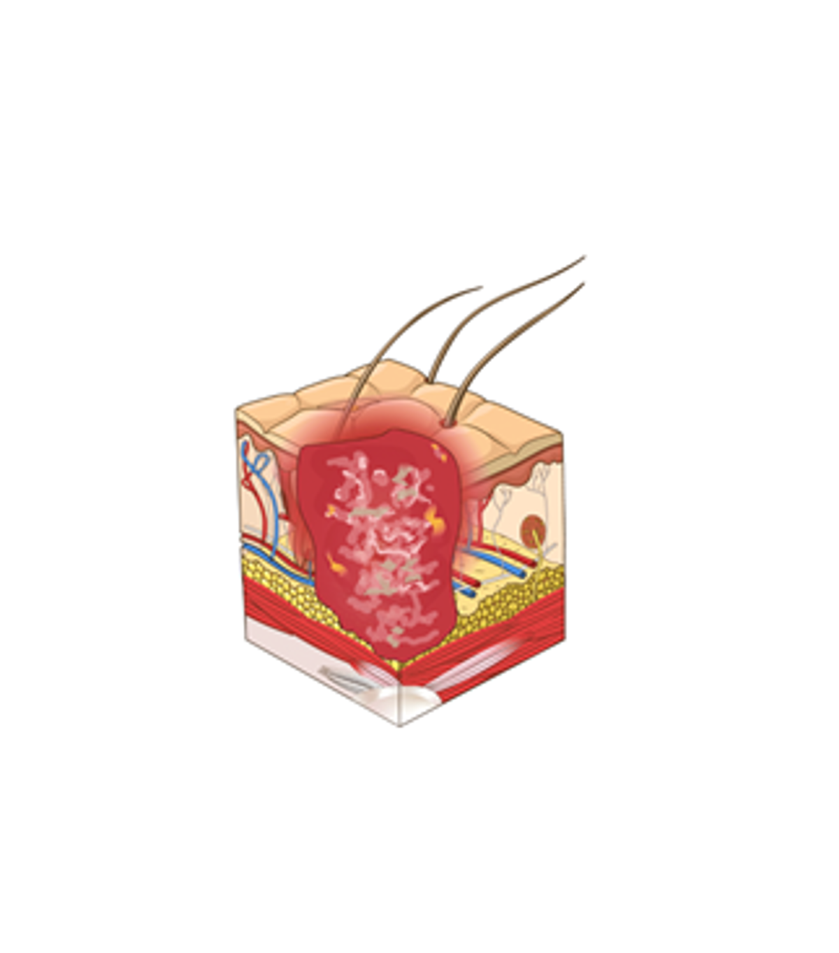 Stage 4: Full-thickness skin and tissue loss