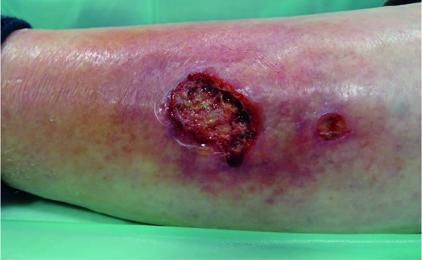 Infected traumatic wound on the lower leg
