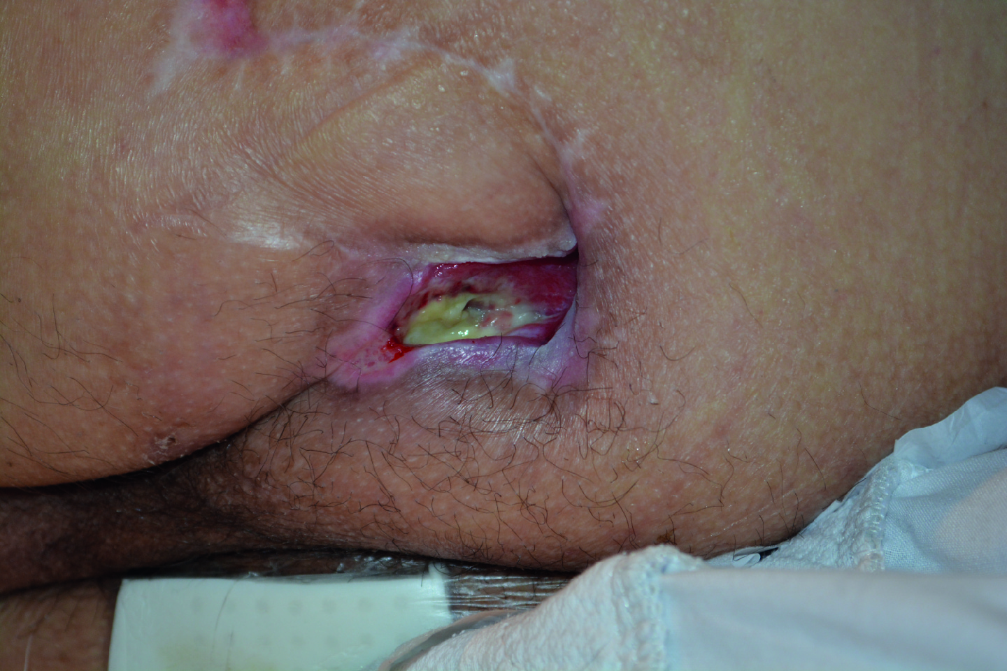 Treatment of recurring pressure ulcer over the left ischium with a silicone foam dressing