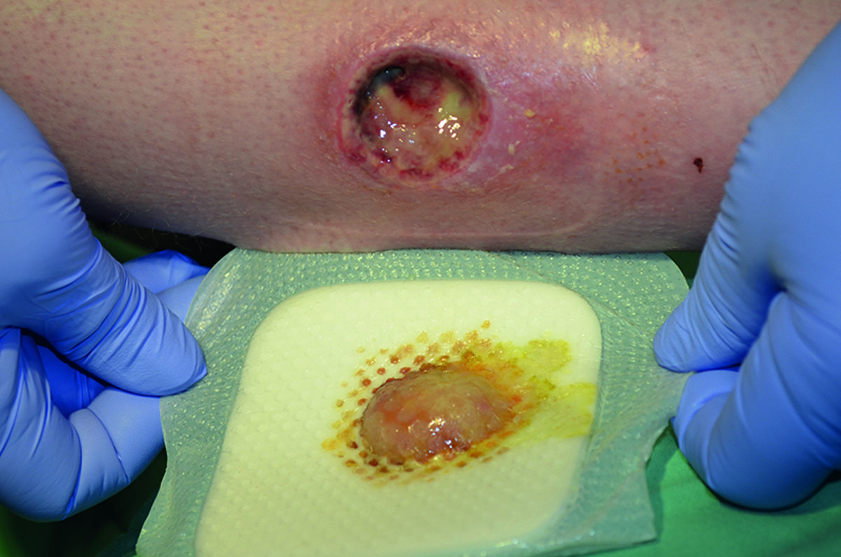 Pressure injury management