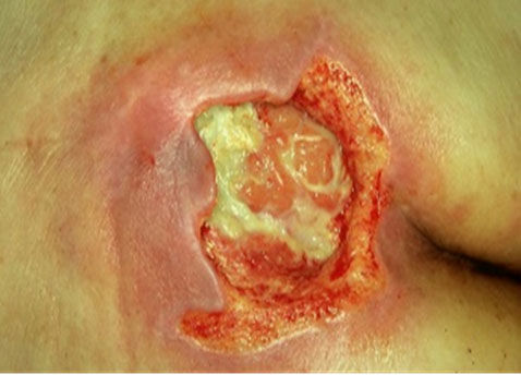 Autolytic debridement