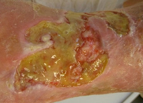 Biological Debridement