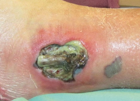 Conservative Sharp Debridement