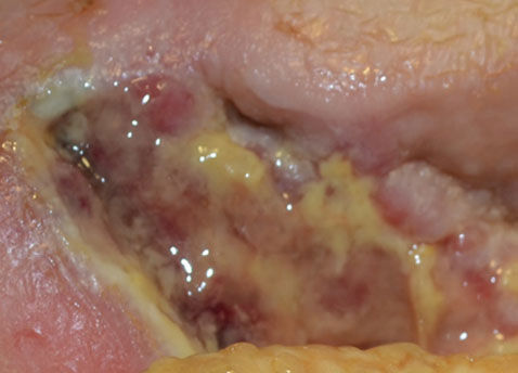 Enzymatic debridement