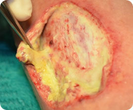 Excess fibrin and slough