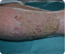 Hyperkeratosis