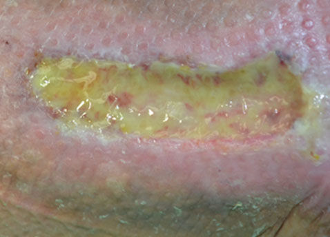 Mechanical Debridement