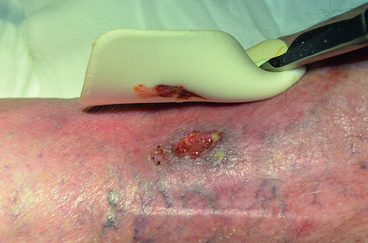 What are the benefits of foam dressings?