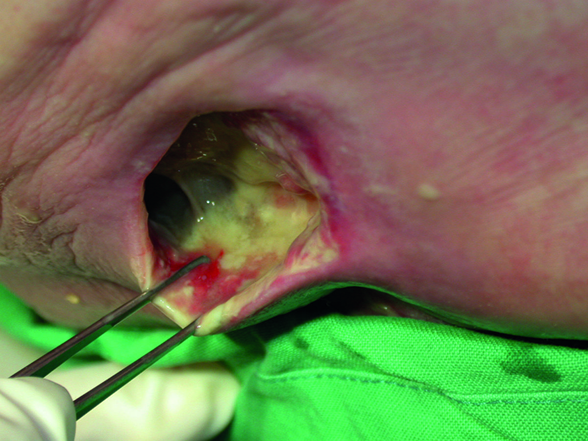 Sacral pressure ulcer with sloughy exudate. Example of a wound where a gelling fibre would be the recommended primaty dressing