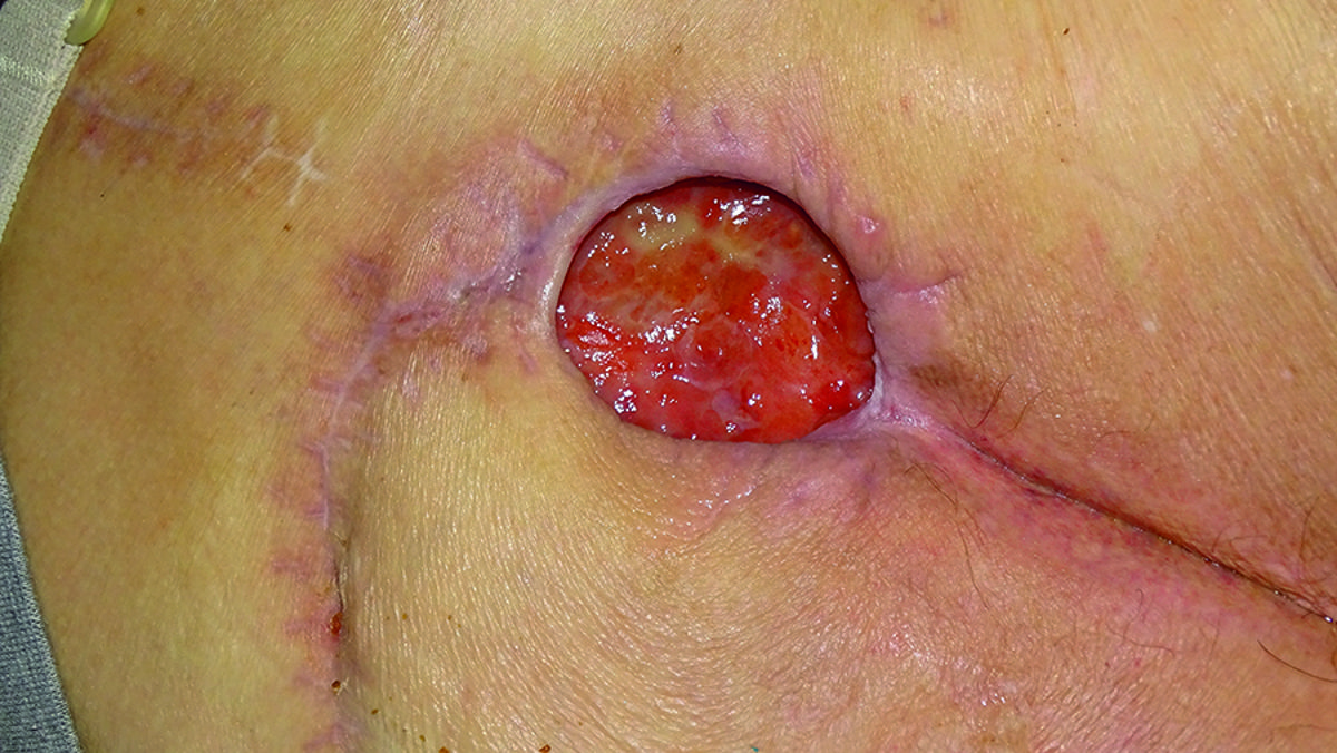 Dressing change after 2 days. Sacral wound after removal of gelling fibre dressing.