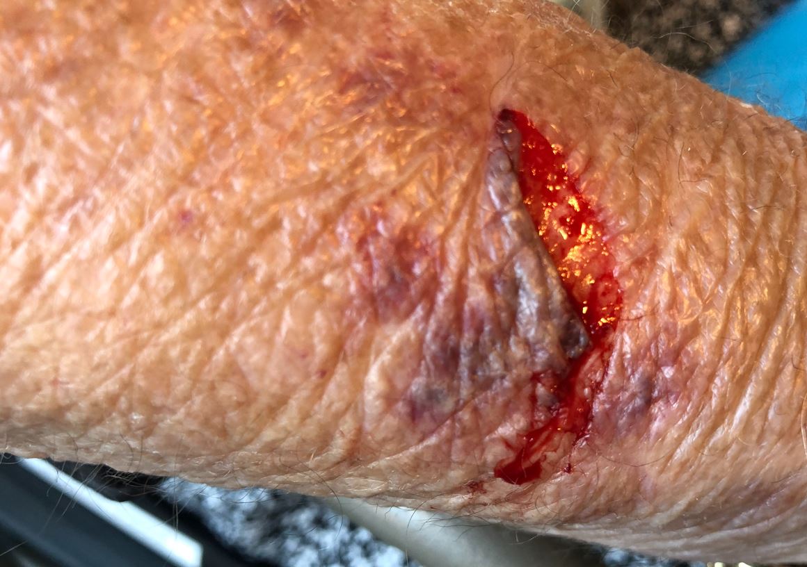 Type 2 Skin Tear