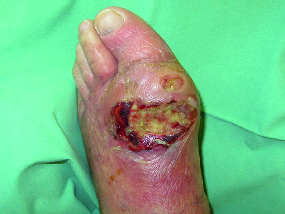 How do I know a diabetic foot ulcer is infected?