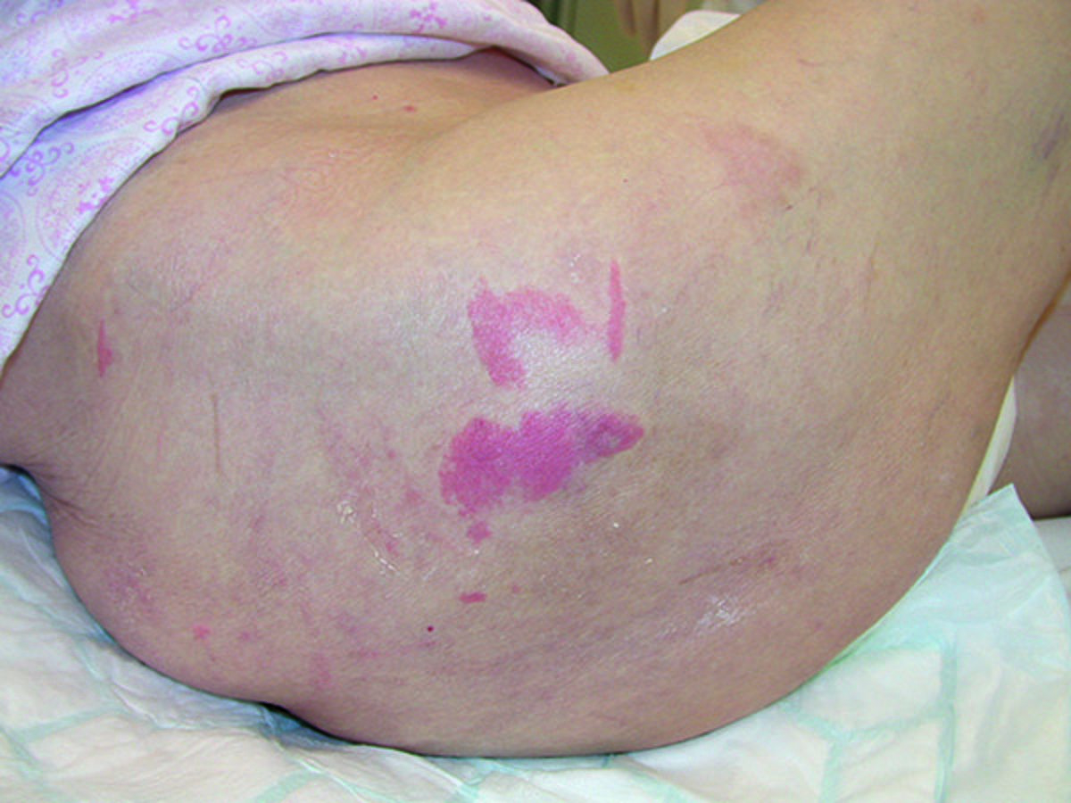 Pressure injury prevention
