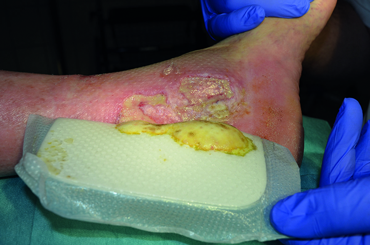 How to manage diabetic foot ulcers