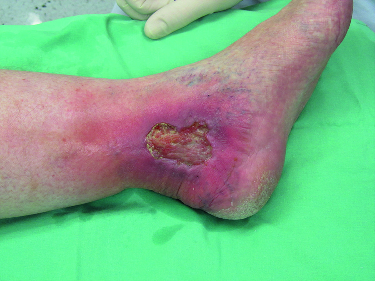Leg ulcers: what are they and how do you treat them?