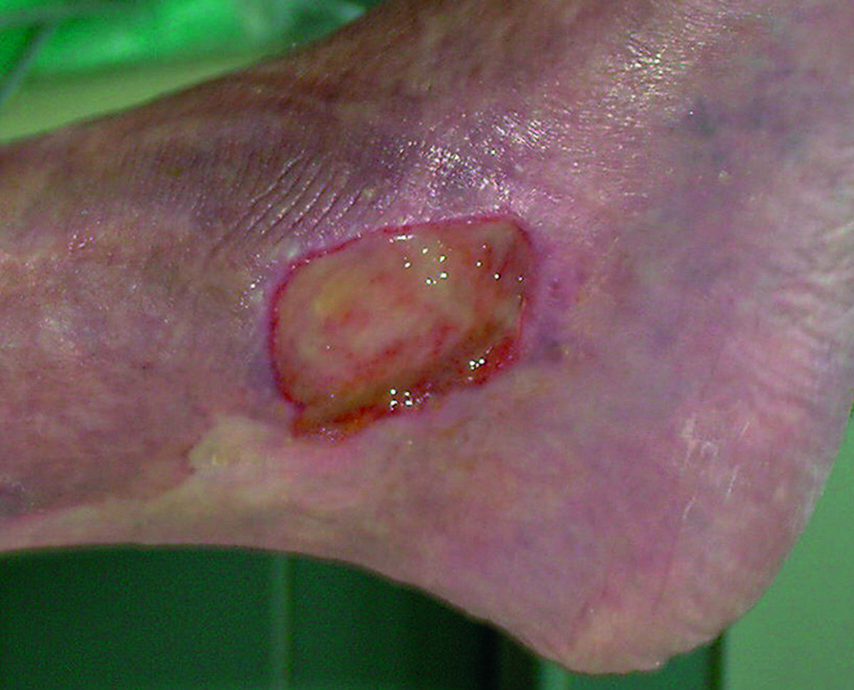 What is a venous leg ulcer and why does it occur? 