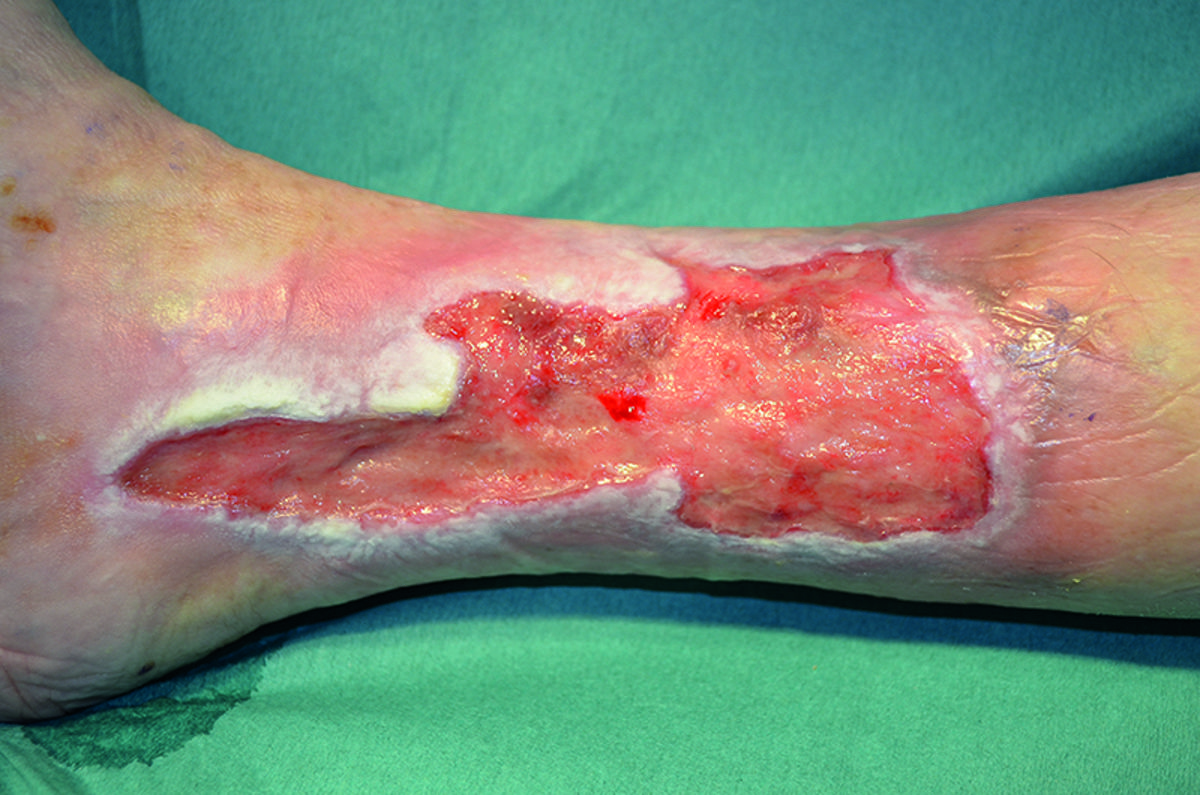 Understanding venous leg ulcers and how to manage them