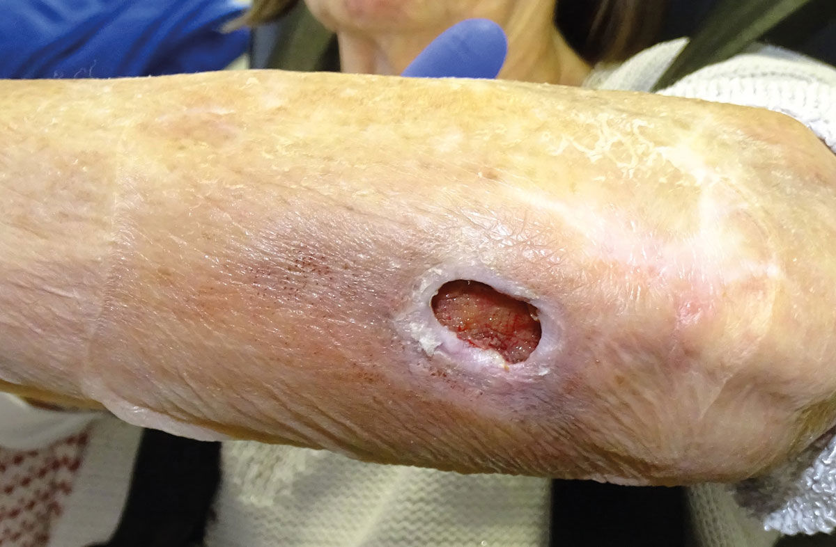 Acute wounds