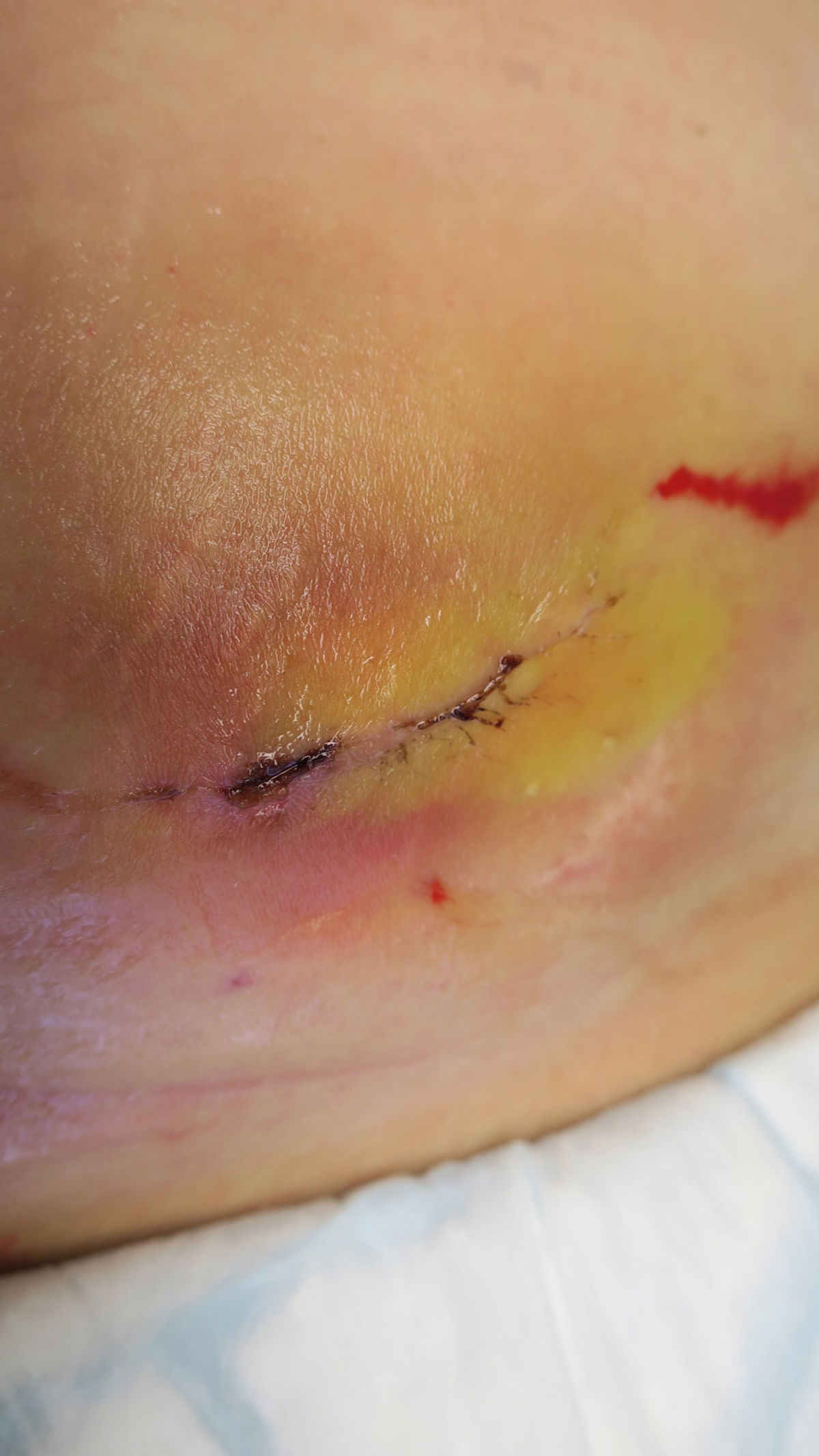 Assessing surgical wounds