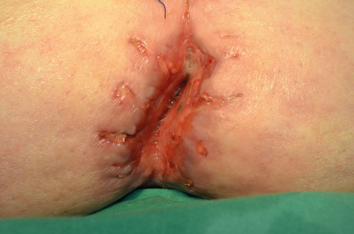What is a surgical site infection?