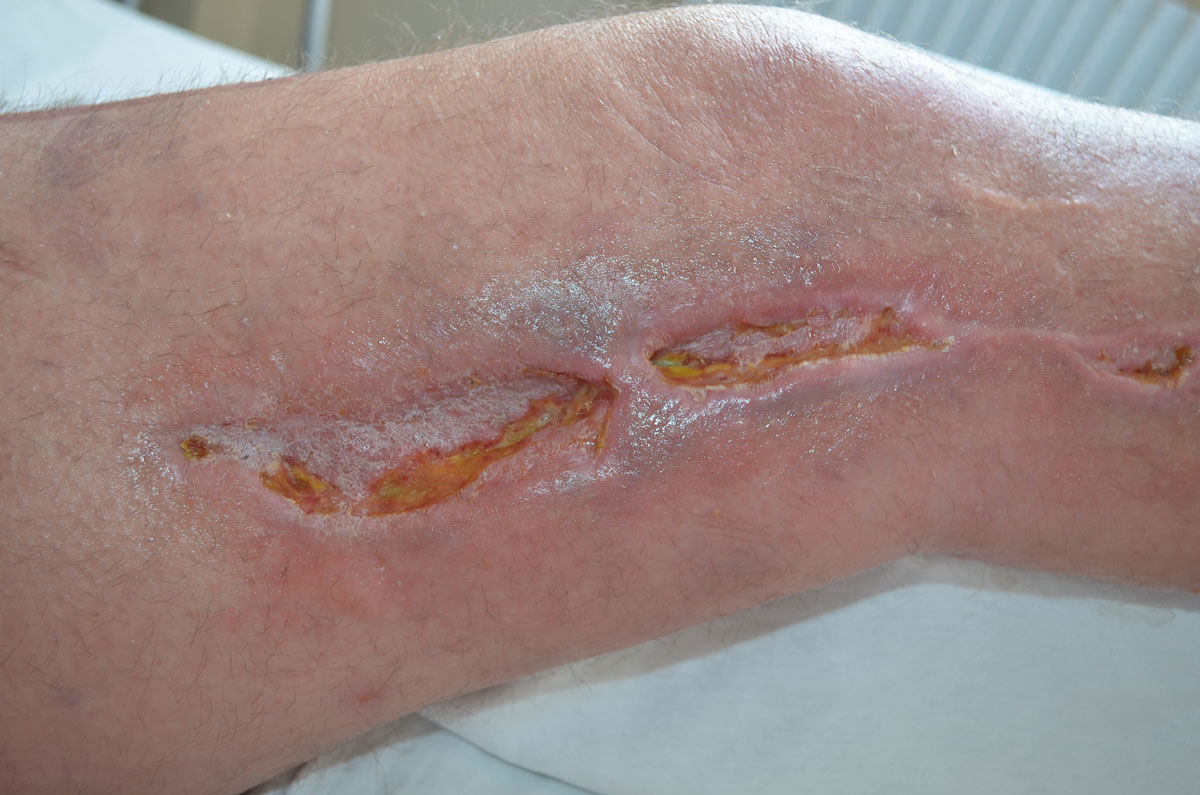 How to treat infection in surgical wounds