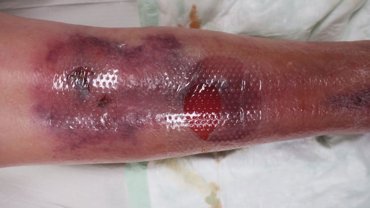 Assessing traumatic wounds