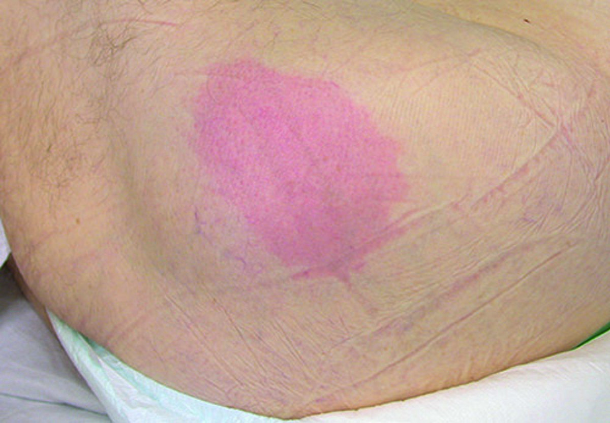 How to classify pressure injuries