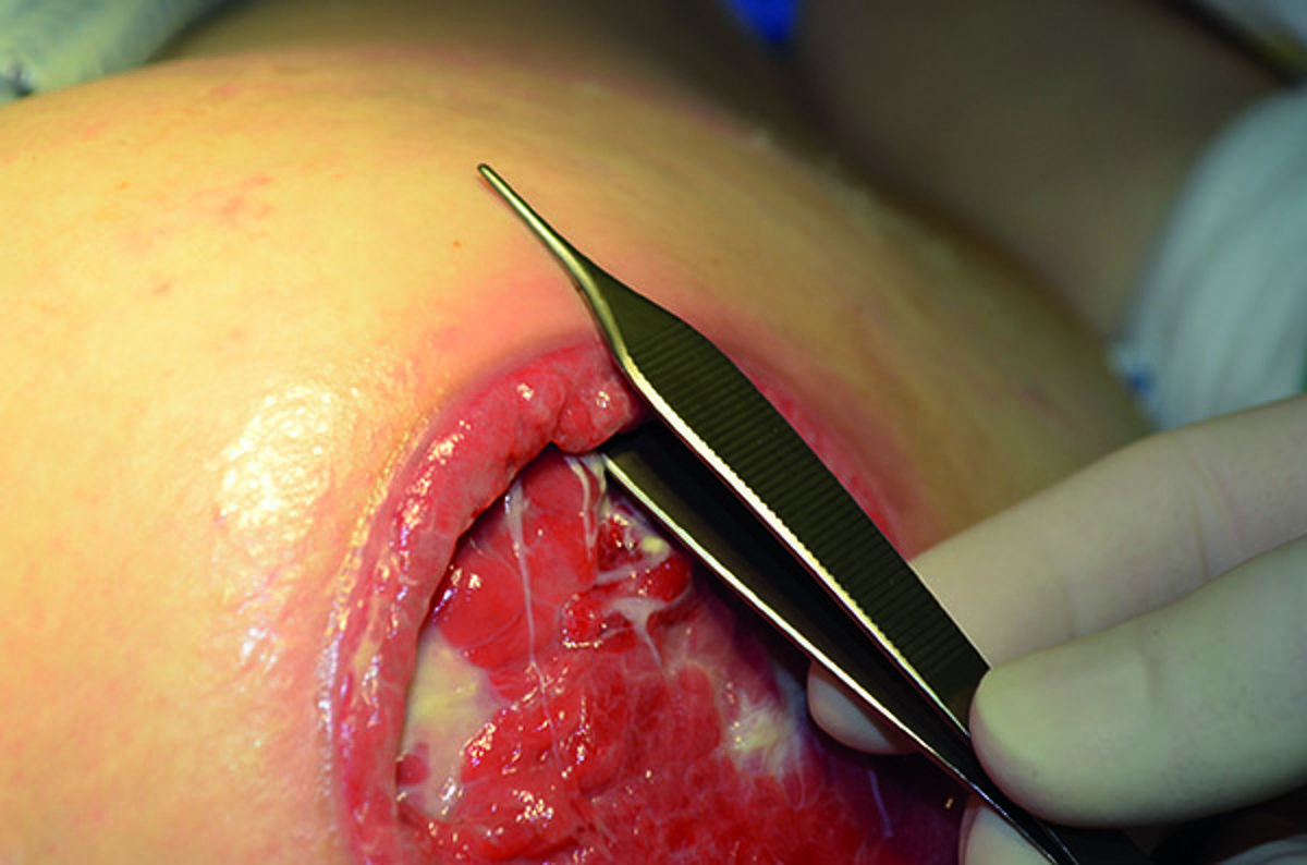 How to assess pressure injuries