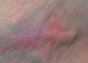 Stage 1 Pressure Ulcer