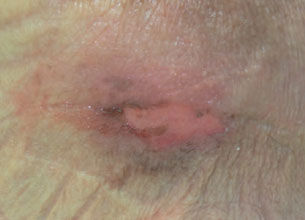 Stage 2 Pressure Ulcer