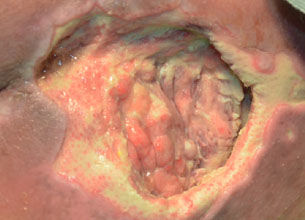 Stage 3 Pressure Ulcer
