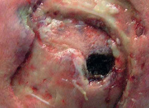 Stage 4 Pressure Ulcer