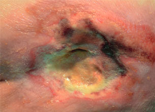 Unstageable Pressure Ulcer
