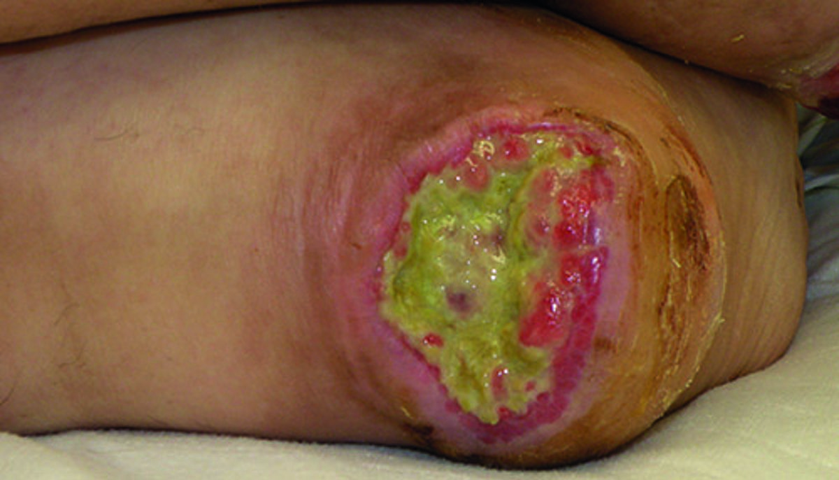 Pressure injuries: what are they and how do you prevent them?