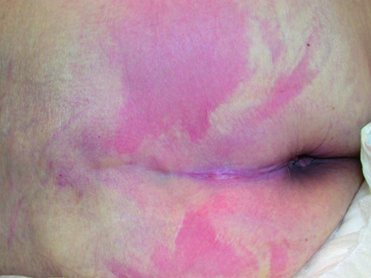 How to prevent pressure injuries