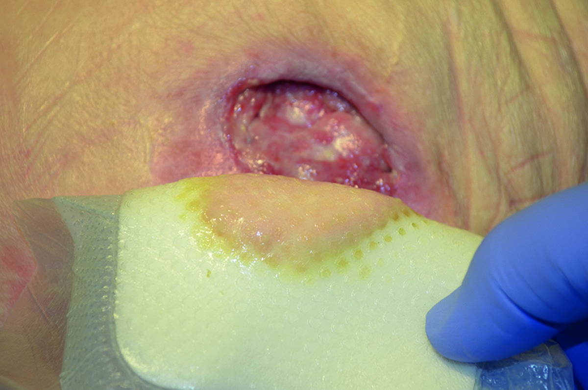 How to use protective dressings