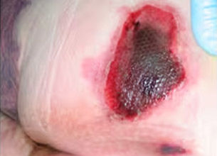Deep Tissue Injury (DTI)
