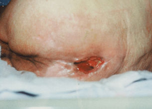 Pressure Ulcer on the lower back.