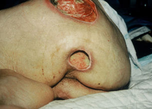 Pressure Ulcer buttocks and leg