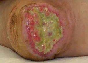 Pressure ulcer on a heel