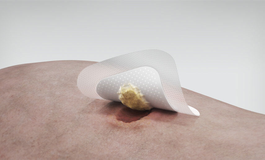 Biatain Silicone observational study Nurses saw progress towards healing
